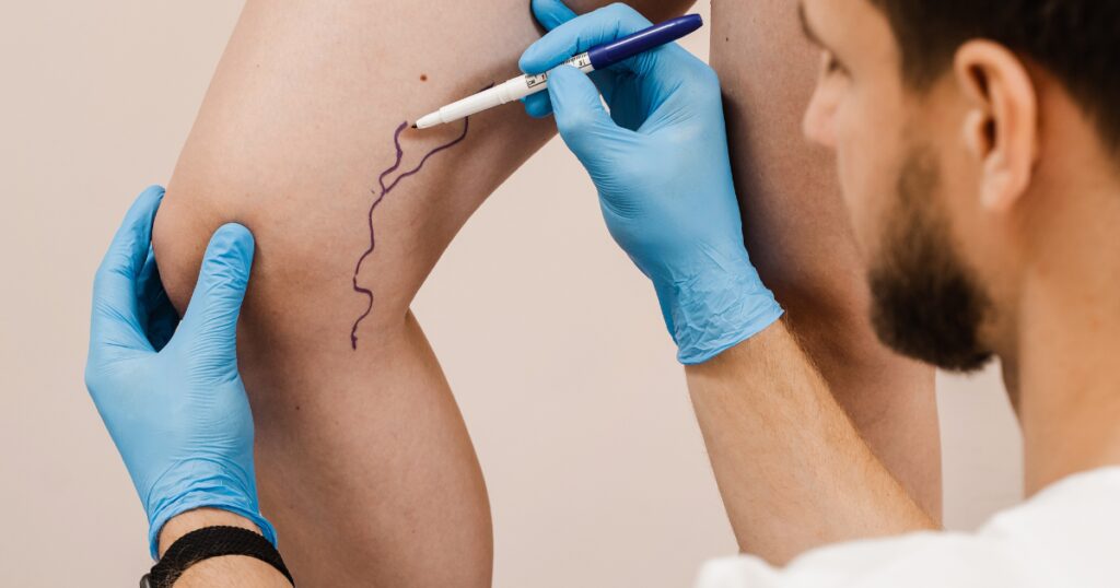 Vein doctor in Peoria Arizona prepping patient for VenaSeal treatment