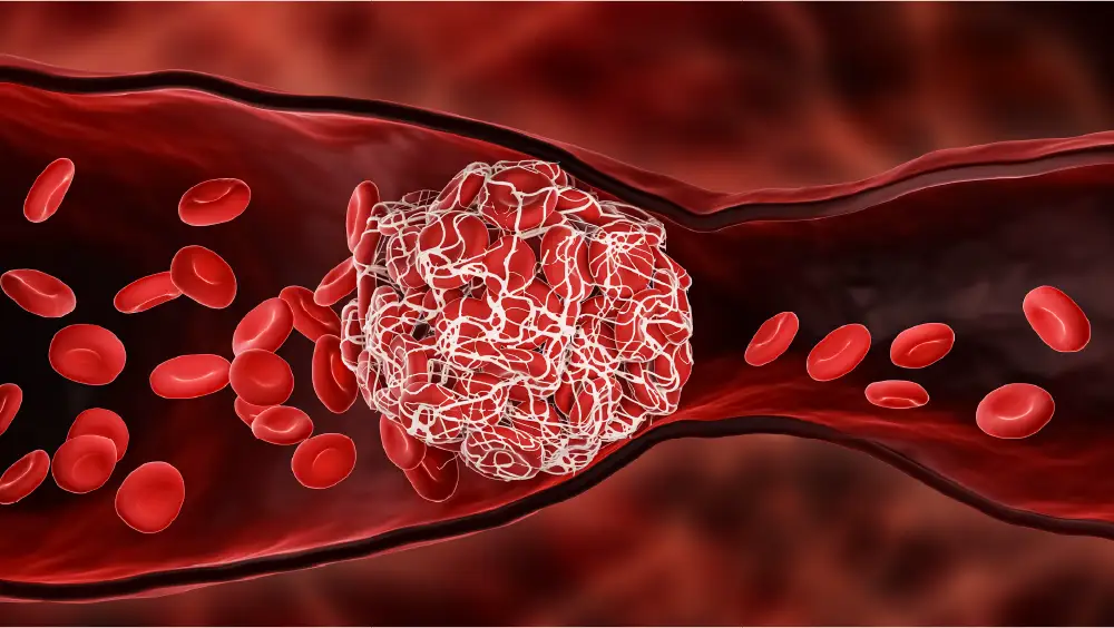 An illustration of a blood clot forming inside a vein
