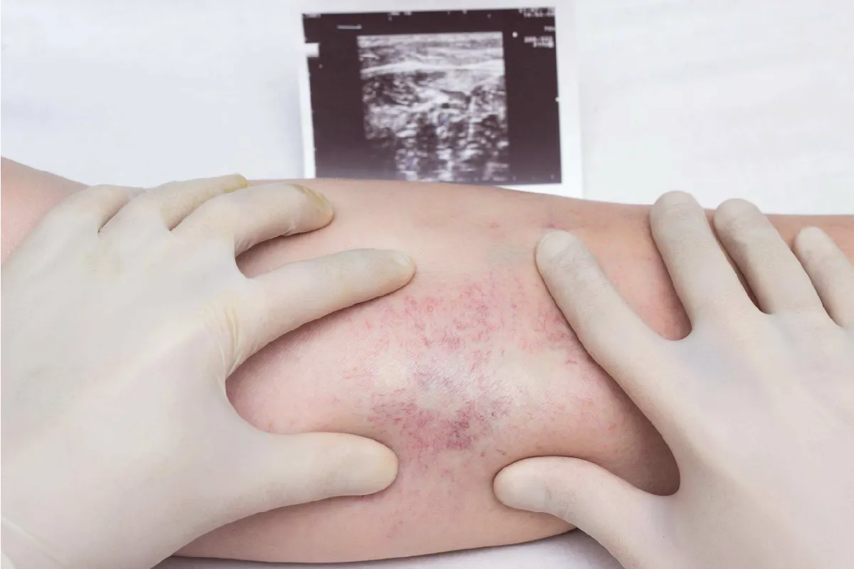 A leg displaying purple visible veins indicating a broken blood vessel or a blood clot.