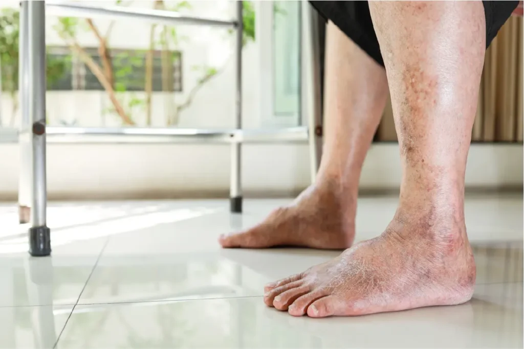 a man's lower legs are shown close up which displaying cracking, dry skin and discoloration indicating venous insufficiency