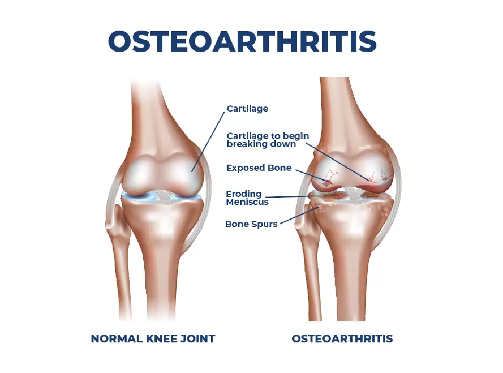 A graphic comparing a normal knee joint and a osteoarthritic knee joint
