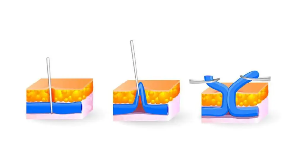 https://unitedveincenters.com/wp-content/uploads/2026/06/phlebectomy_graphicAsset-3.webp