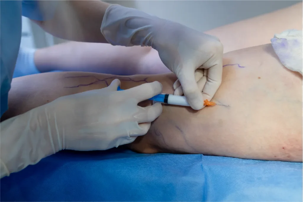 A vein doctor performing sclerotherapy injection on a patient's visible leg veins