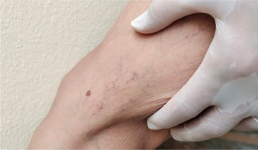 A close up of a person's leg displaying purple, squiggly veins under the skin's surface