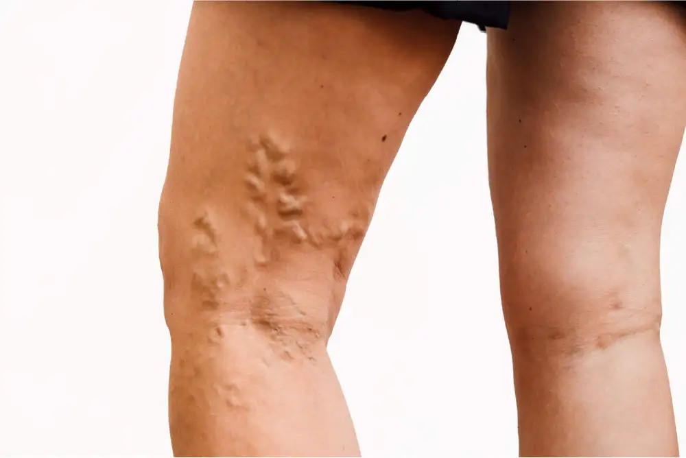 https://unitedveincenters.com/wp-content/uploads/2026/06/varicose_Veins_on_legsAsset-1.webp