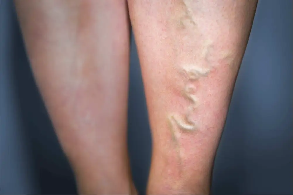 A close-up of a woman's lower legs displaying a bulging, blue varicose vein