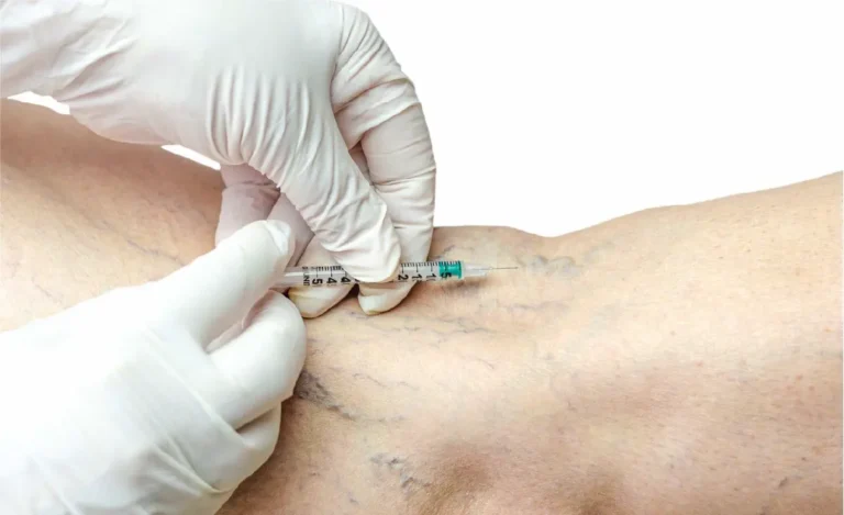 Varithena foam injection vein treatment for venous reflux