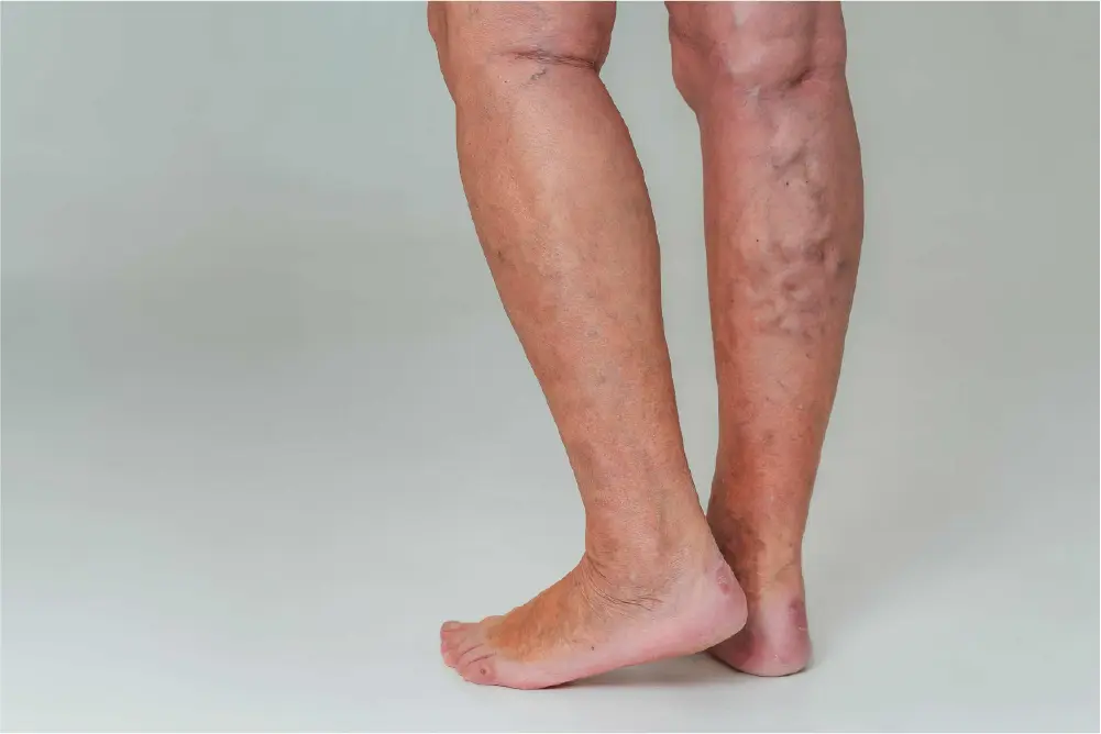 Vein restoration for bulging varicose veins on a woman's legs