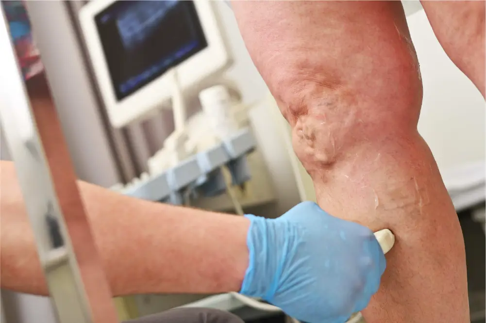 A vein specialist performing a vein ultrasound on a patient's lower leg while standing