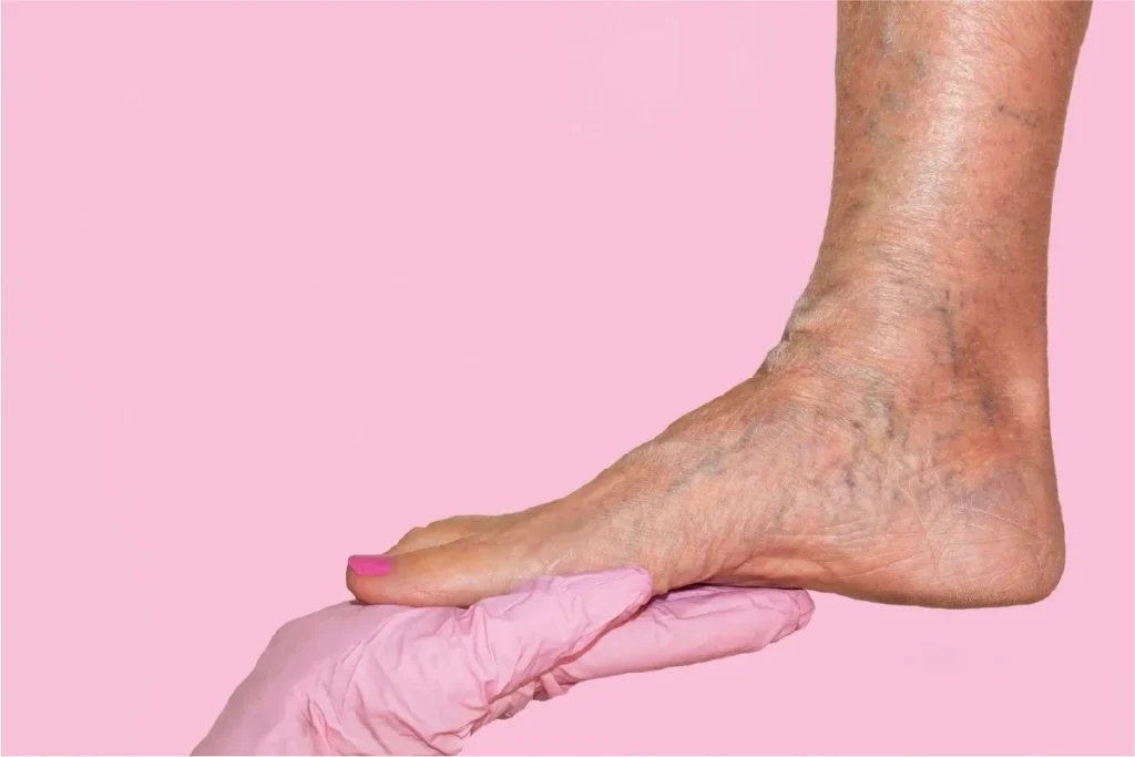 Venous clinical severity score measures the level of chronic venous insufficiency