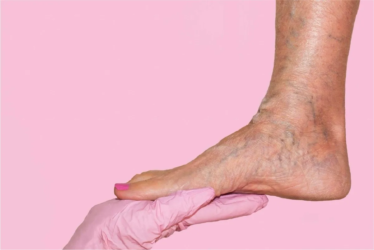 Venous clinical severity score measures the level of chronic venous insufficiency