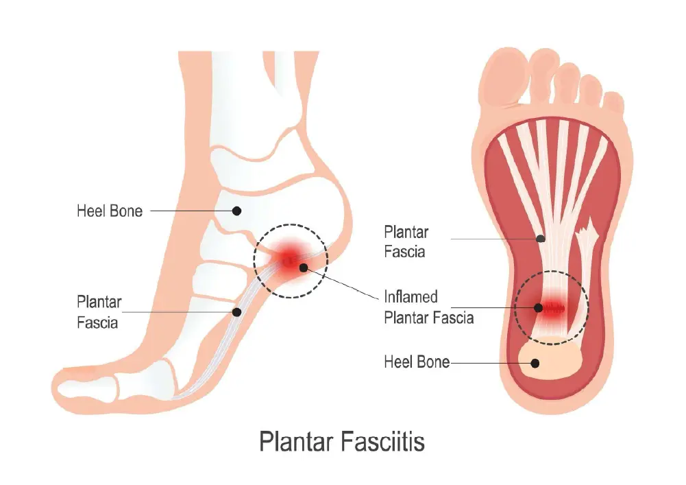 https://unitedveincenters.com/wp-content/uploads/2026/06/what-is-plantar-fasciitis.webp