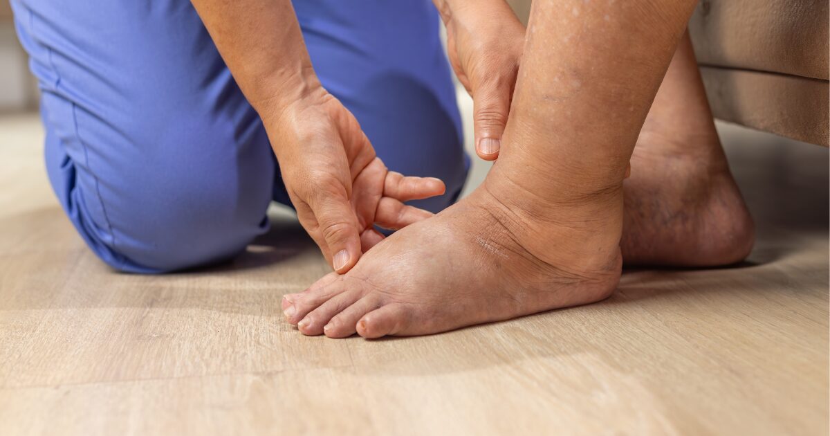 patient foot showing symptoms of CVI or Lymphedema