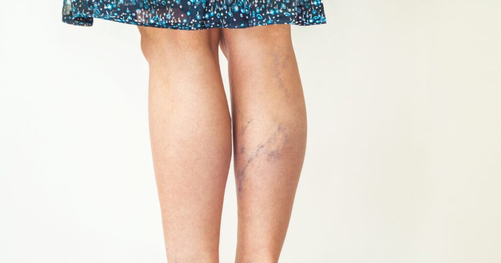 patients legs