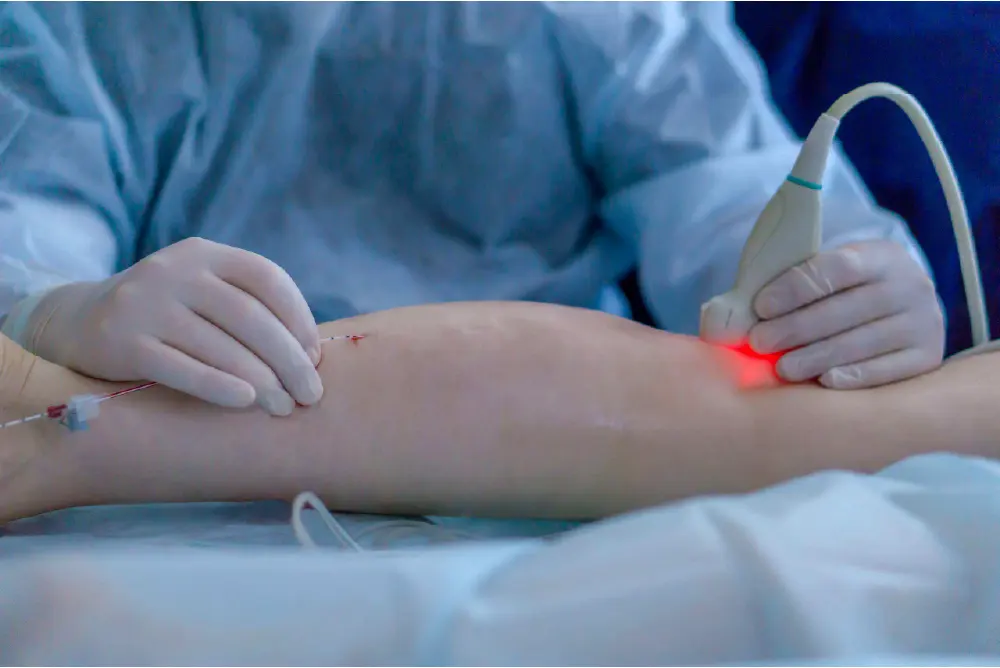 https://unitedveincenters.com/wp-content/uploads/2026/07/reticular-vein-treatment.webp