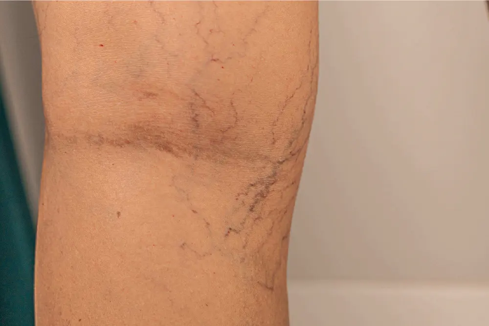 https://unitedveincenters.com/wp-content/uploads/2026/07/reticular-veins-behind-knee.webp