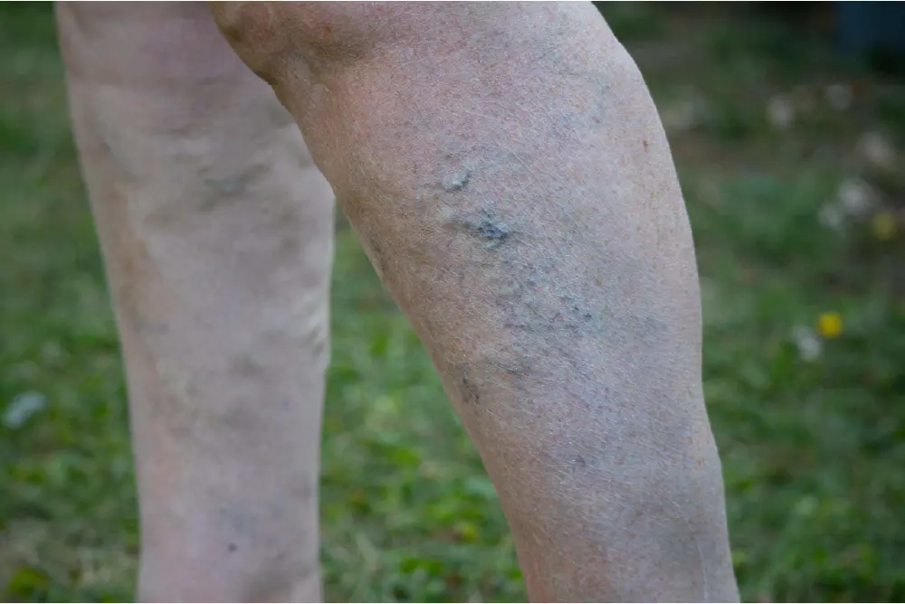 https://unitedveincenters.com/wp-content/uploads/2026/07/reticular-veins-on-lower-leg.webp