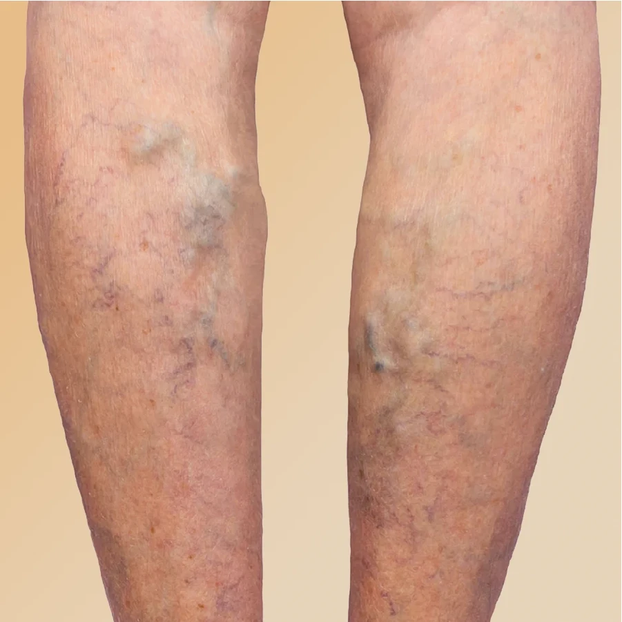 https://unitedveincenters.com/wp-content/uploads/2026/07/varicose-veins.webp