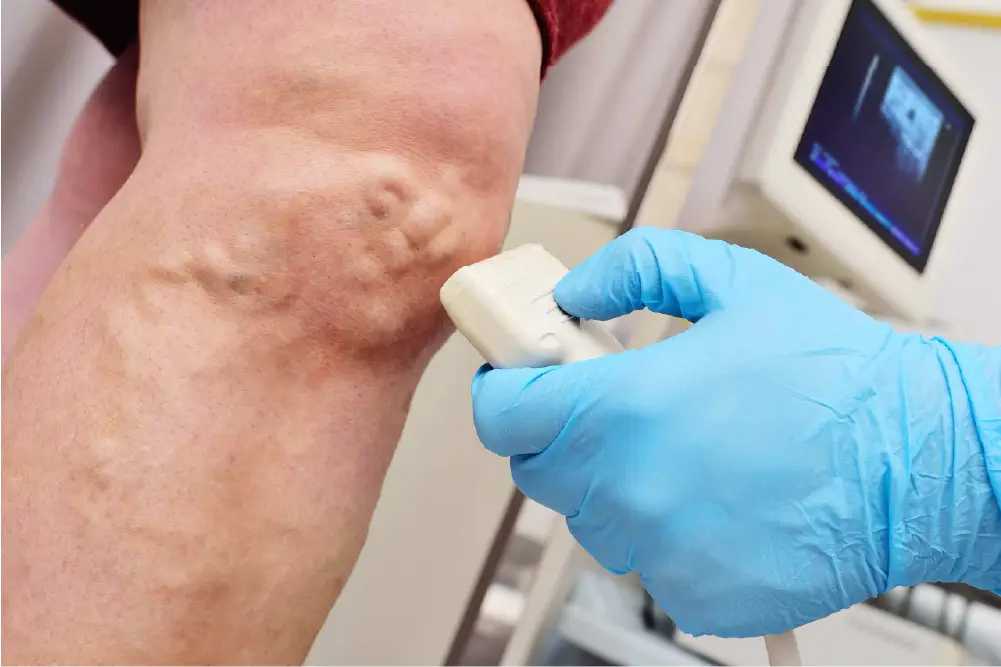 vein ultrasound being performed a person's leg with varicose veins