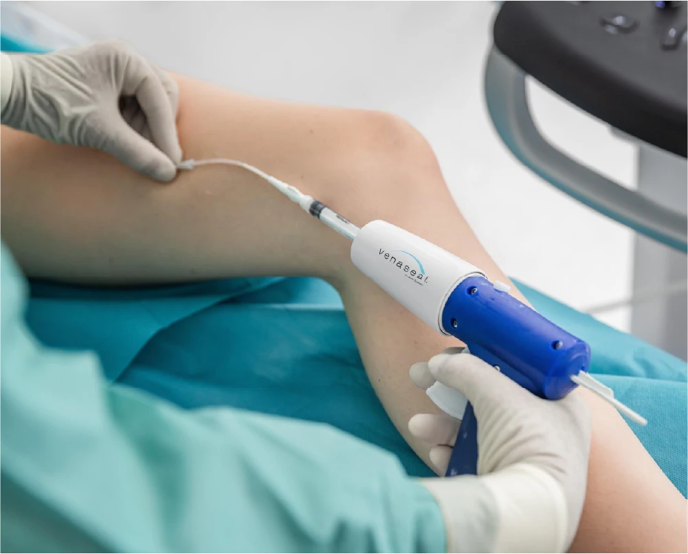 https://unitedveincenters.com/wp-content/uploads/2026/07/venaseal-for-varicose-veins.webp