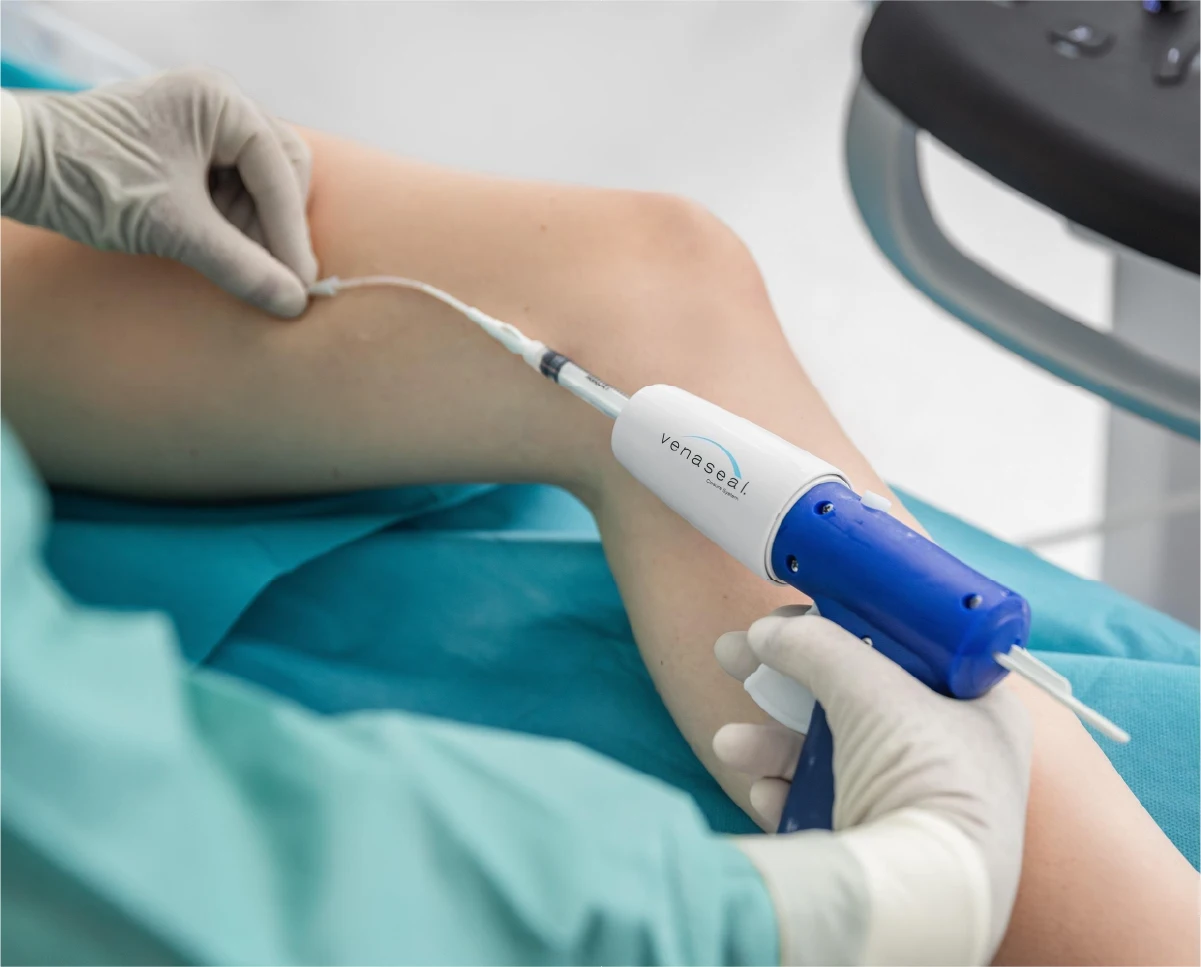 https://unitedveincenters.com/wp-content/uploads/2026/07/venaseal-vein-treatment-1024x824.webp