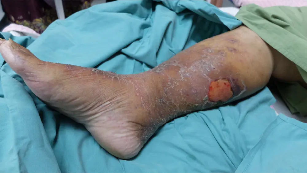 https://unitedveincenters.com/wp-content/uploads/2026/08/cvi-can-lead-to-venous-ulcers-if-left-untreated.webp