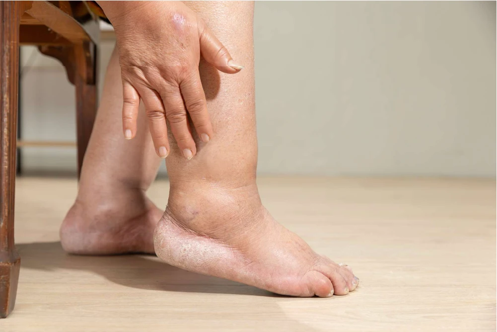 Leg swelling is a common symptoms of vein disease