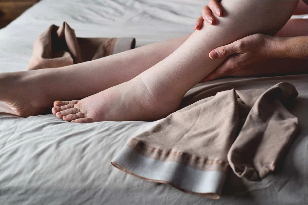 https://unitedveincenters.com/wp-content/uploads/2026/08/leg-swelling-can-be-treated-with-compression-therapy.webp