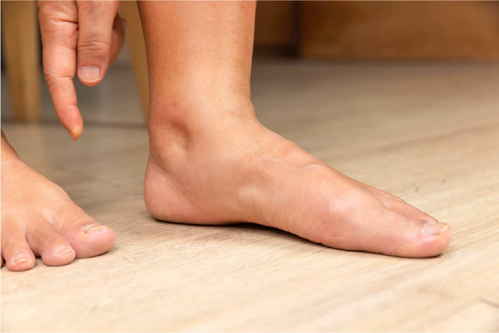 Pitting edema indentation shown on a person's ankle