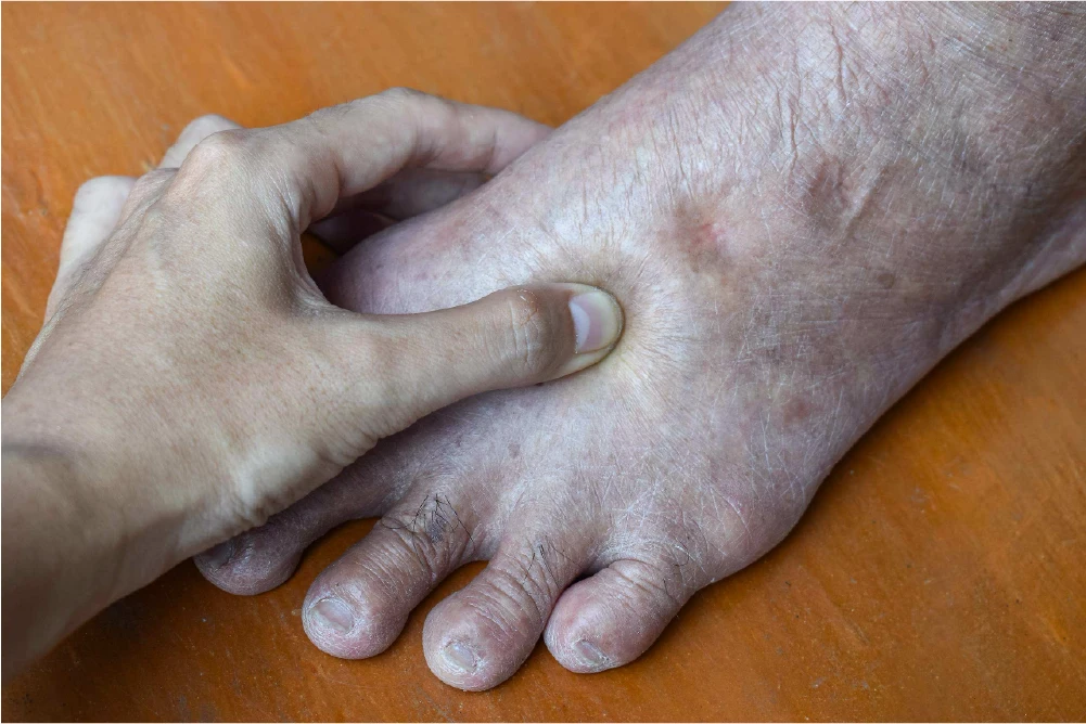Pitting edema indentations on the top of a foot