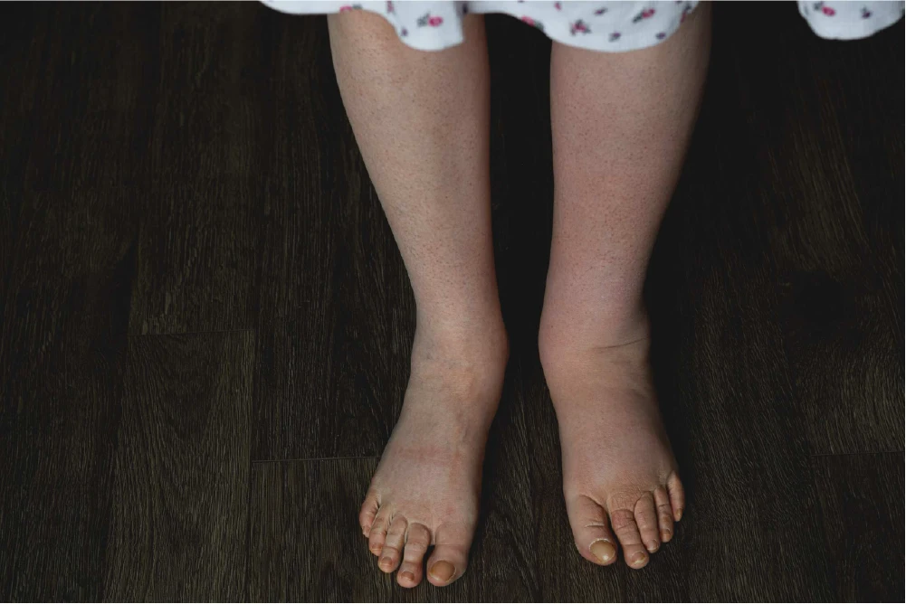 https://unitedveincenters.com/wp-content/uploads/2026/08/rfa-treats-leg-swelling.webp