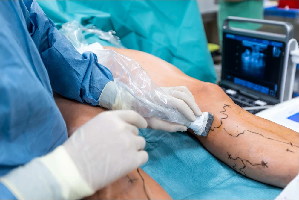 A venous procedure being performed on a patient's lower leg