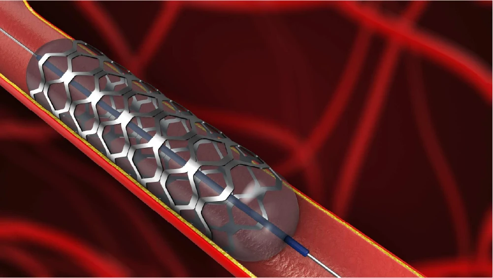 PAD treatment may include stenting