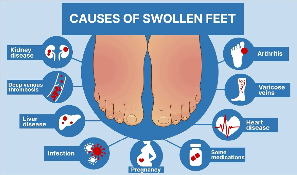 Causes of swollen feet infographic
