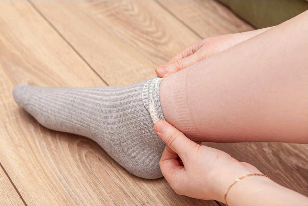 Indentation from sock on lower leg