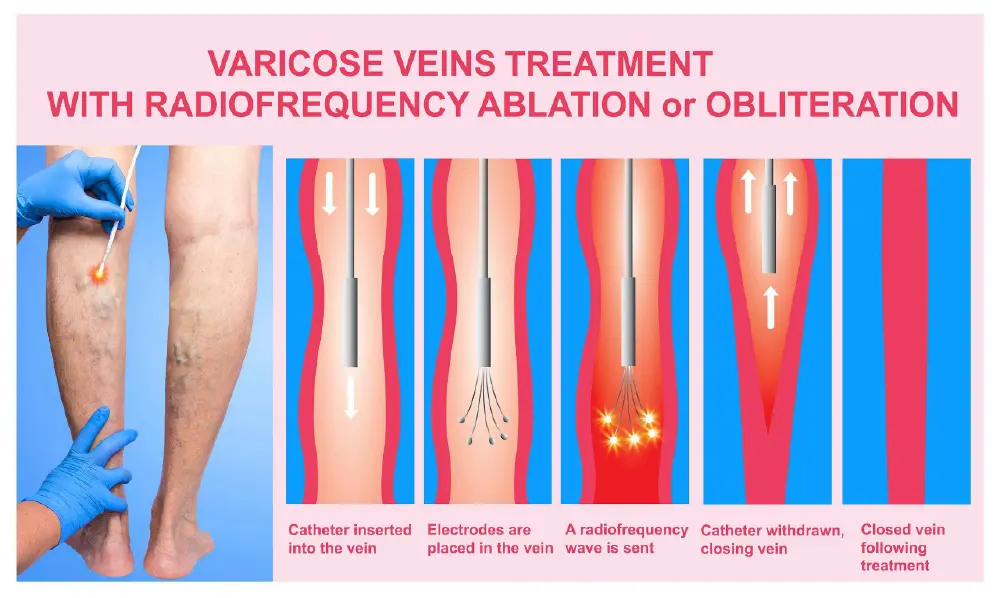 Varicose vein treatment can help stop nighttime foot cramps