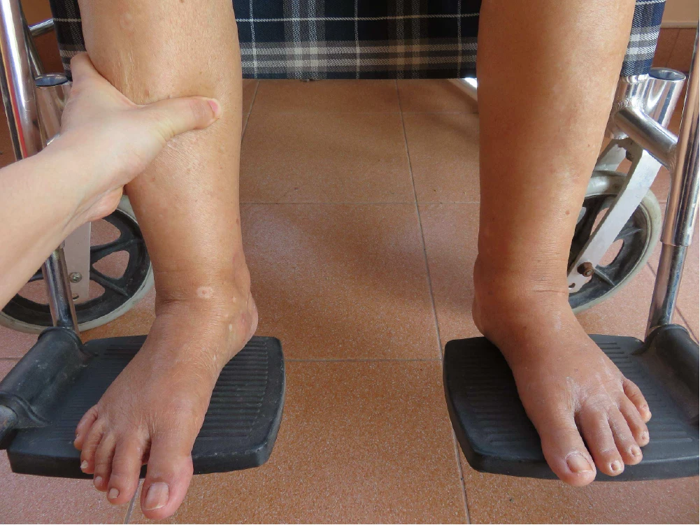 Water retention in lower legs