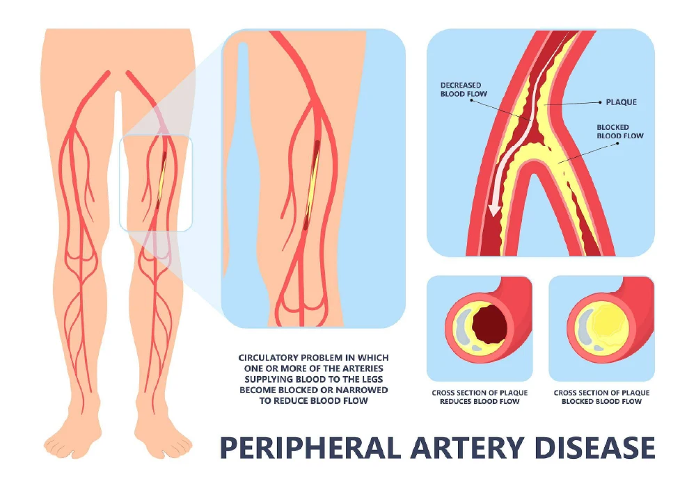 PAD infographic