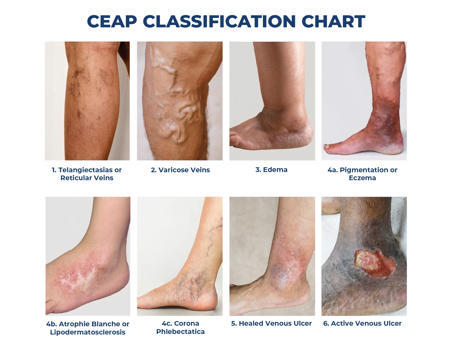 https://unitedveincenters.com/wp-content/uploads/2026/10/CEAP-Vein-Disease-Classification-Chart-1024x795.webp