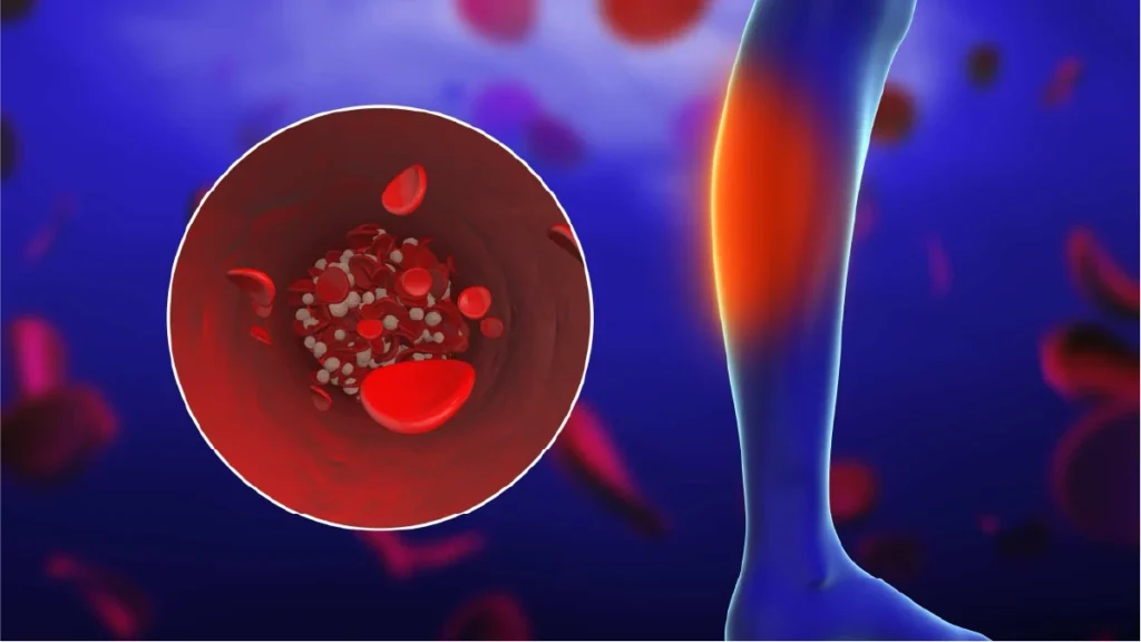 Illustration of a blood clot forming in the leg