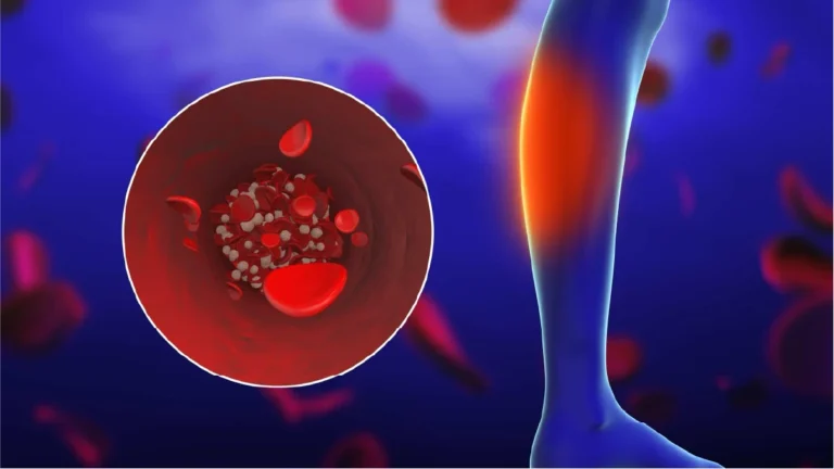 Illustration of a blood clot forming in the leg