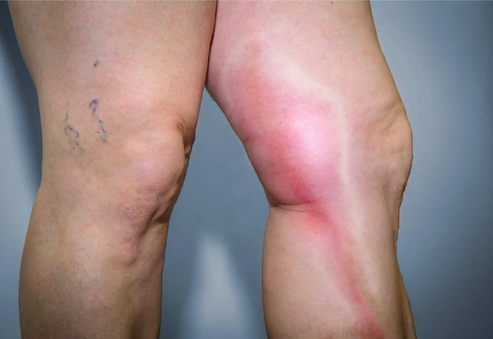DVT in leg