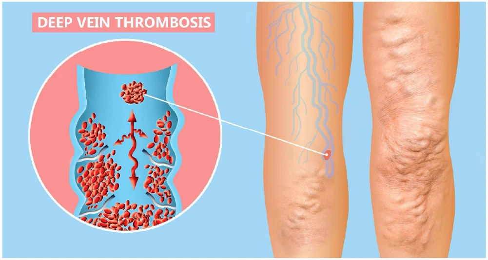 graphic of deep vein thrombosis (DVT)
