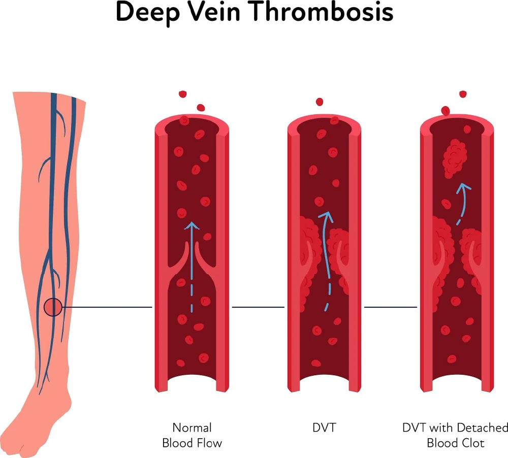 Graphic showing the stages of how a blood clot forms