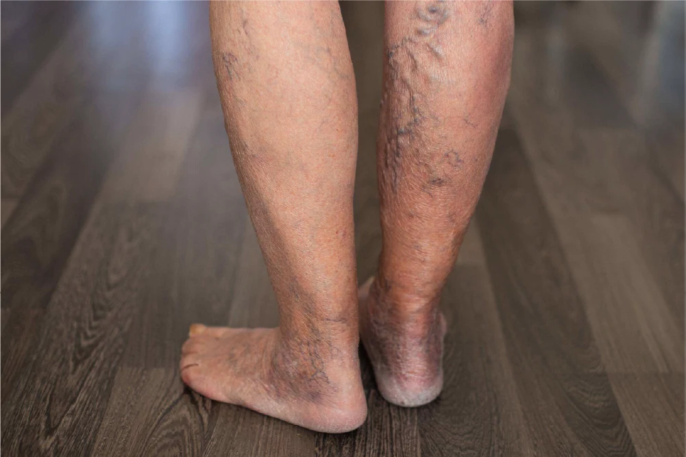 symptoms of vein disease include leg pain