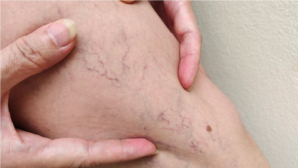 Visible veins look blue and purple under the skin